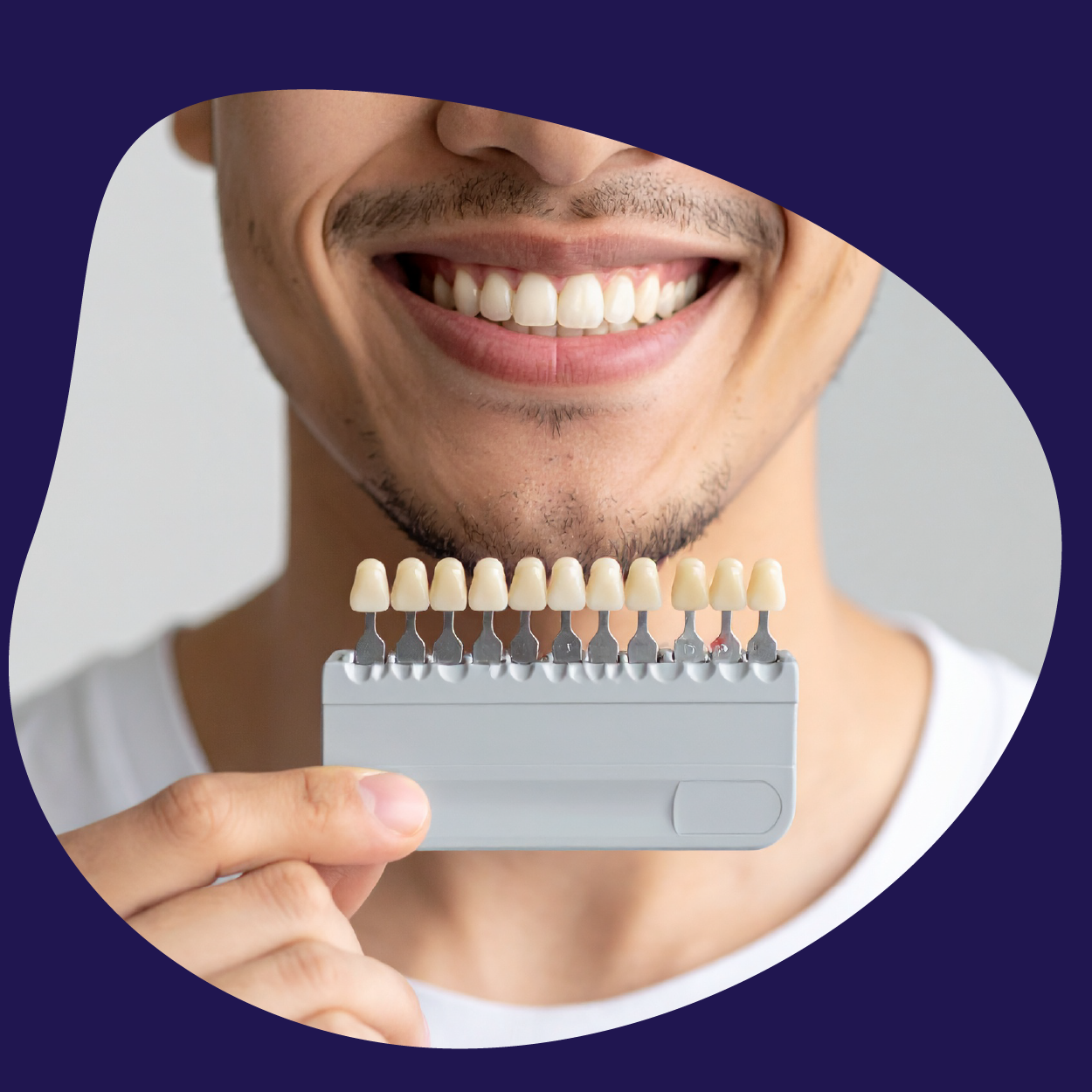 Professional vs At Home Teeth Whitening | SmileCart.ae